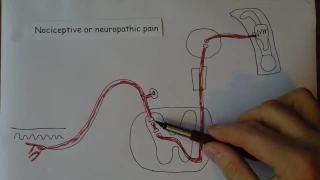 Neuropathic pain.