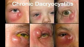 Chronic Dacryocystitis: Long Case