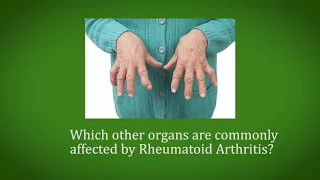 Commonly affected organs in Rheumatoid Arthritis? | Rheumatoid Arthritis Causes - Manipal Hospitals