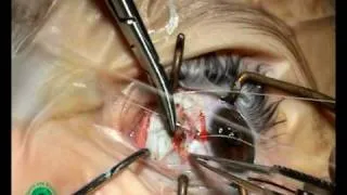 Strabismus surgery p 15/54