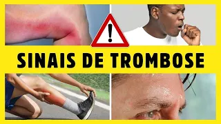 TROMBOSE: 10 SINAIS E SINTOMAS e 12 CAUSAS da trombose (esteja alerta e proteja-se!) Dr Alain Dutra