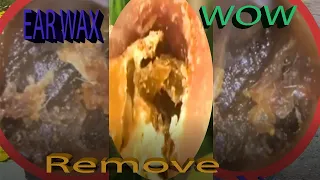 Most Irritating Ear Wax  Deep Impacted Hard Stuck Ear Wax Removal. Spa EP1125