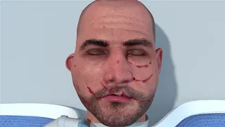 Facial Reconstruction Surgery Animation