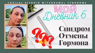 6. Дневник: Синдром Отмены Гормональной мази. Элидел отзыв. Topical Steroid Withdrawal Syndrome.