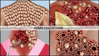 ASMR Treatment Animation Compilation Removal Of Dog Ticks | Universe 팅거 ASMR