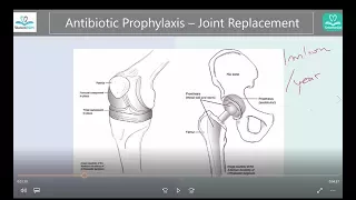 Antibiotic prophylaxis - Joint replacement, YES or NO? Answers + Where to find the guidelines