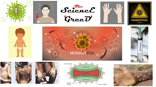 What is the monkeypox virus? Basic information, Symptoms, diagnosis and Prevention. Science Today