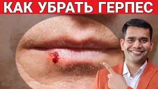 Избавьтесь От Герпеса | Попробуйте Это, Если Вы Страдаете От ГЕРПЕСА- Доктор Вивек