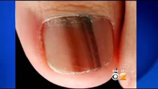 Doctors Warn Of Potentiall Deadly Form Of Nail Cancer