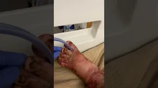 Maggot foot