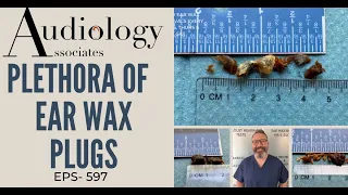 PLETHORA OF EAR WAX PLUGS REMOVED - EP597