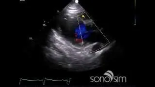 SonoSim Ultrasound Challenge: SonoSim Ultrasound Challenge - Cardiology