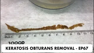 11 CM PIECE OF SKIN BLOCKAGE REMOVED FROM PATIENTS EAR - EP67