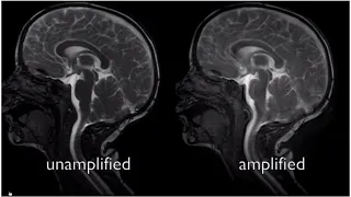 Chiari Malformation l video