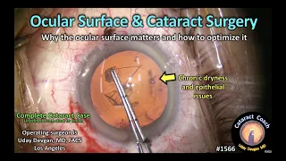 CataractCoach 1566: the ocular surface and cataract surgery