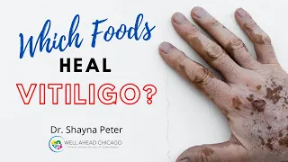 Which Foods Heal Vitiligo? | Is Diet Really Enough to Cure Vitiligo? | Vitiligo Functional Medicine