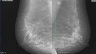 TMT: Breast Imaging by Dr Shanti Shetty: Architectural Patterns on Mammography