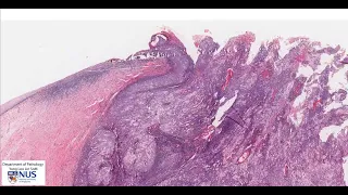 Uterine cervix squamous cell carcinoma microscopy - Talking slide