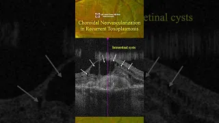 Choroidal neovascularization in recurrent toxoplasmosis.