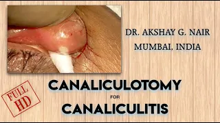 Canaliculotomy for Canaliculitis / Canalicular Curettage : Dr. Akshay G. Nair - Mumbai.