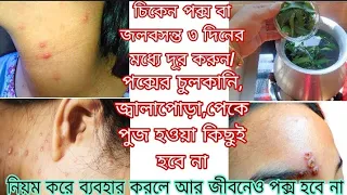 চিকেন পক্স বা জলবসন্ত ৩ দিনের মধ্যে সারিয়ে তুলার উপায়/এই ঘরোয়া টোটকা জানা থাকলে পক্সে চুলকানি হবেনা