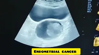 Endometrial cancer ♋