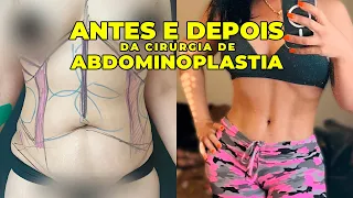 ANTES E DEPOIS DA ABDOMINOPLASTIA