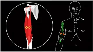 The arm hurts from the shoulder to the elbow. Musculus biceps brachii