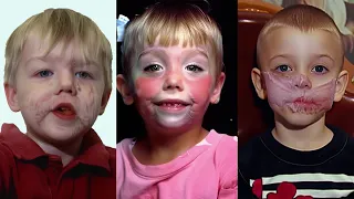 15 Kids’ Lives Transformed By Plastic Surgery