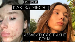 КАК ИЗБАВИТЬСЯ ОТ ПРЫЩЕЙ БЫСТРО?💕|ЛЕЧЕНИЕ АКНЕ|Чистая кожа 🤩Мой опыт Питание и Советы!