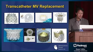 Transcatheter Mitral Valve Replacement: Repair, Replace or Do Nothing?