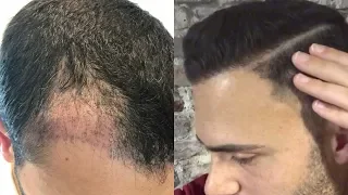 Haartransplantation Vorher Nachher 8 Monate Mega!