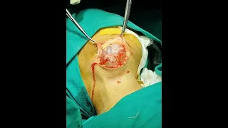 submandibular cystic lesion. excision. dr jalil mujawar