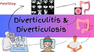 DIVERTICULITIS and DIVERTICULOSIS EXPLAINED | The Low Fiber Diet Disease !