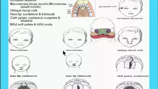 17  Commonest Anomalies of the face palate