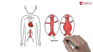 What is an Abdominal Aortic Aneurysm?