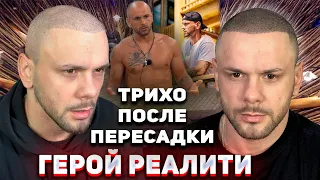 Трихопигментация после пересадки волос для героя реалити. Scalp Micropigmentation.