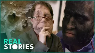 Adam Pearson: Freak Show (Medical Conditions Documentary) | Real Stories
