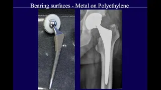 Radiographic analysis of prosthetic hip