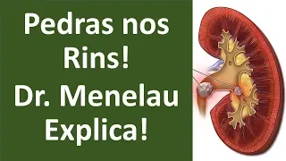 Pedras nos rins! Dr  Menelau explica!