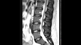 Importance of STIR images in lumbar spine