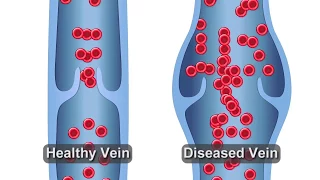 Refluxing Vein Animation