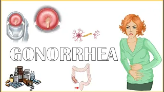 Gonorrhea - Causes, Signs & Symptoms, Diagnosis, And Treatment