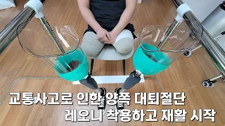 교통사고로 인한 양쪽 대퇴절단 레오니 착용하고 재활 시작