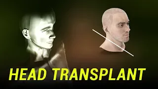 What Happened to the Head Transplant?