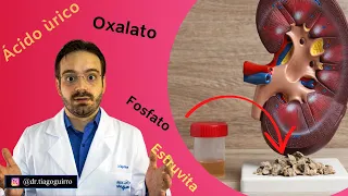 Você Precisa Saber Qual o Tipo do Seu Cálculo Renal!