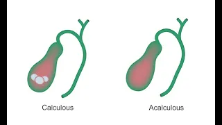 Identifying acute cholecystitis