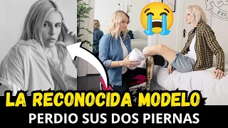 FUE MUY DOLOROSO! La reconocida modelo que perdio sus dos piernas por culpa de un  tampon.