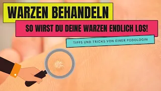 WARZEN BEHANDELN | So wirst du WARZEN endlich los!