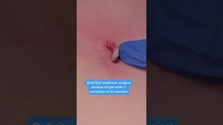 #shorts TW: Extracting a Dilated Pore with an Underlying Cyst